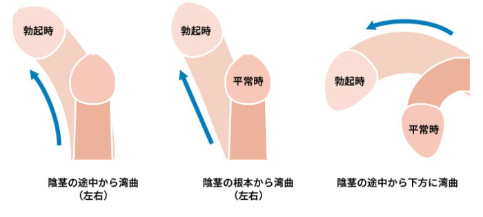 陰茎湾曲のイラスト