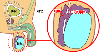 精管を2箇所切断の図解
